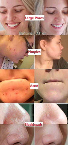 Green Mask Stick Black Head & Acne Remover - 100% Original