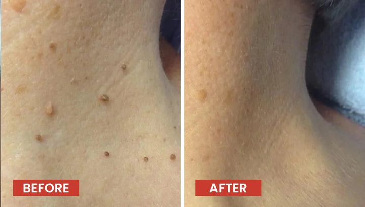 Derma Smooth Skin Tag Removal Patch (72 Pcs)